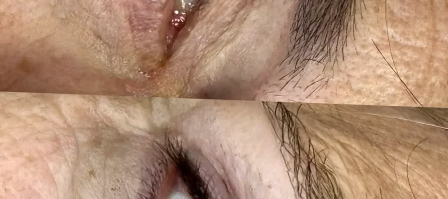 itchy eyes after eyeliner tattoo