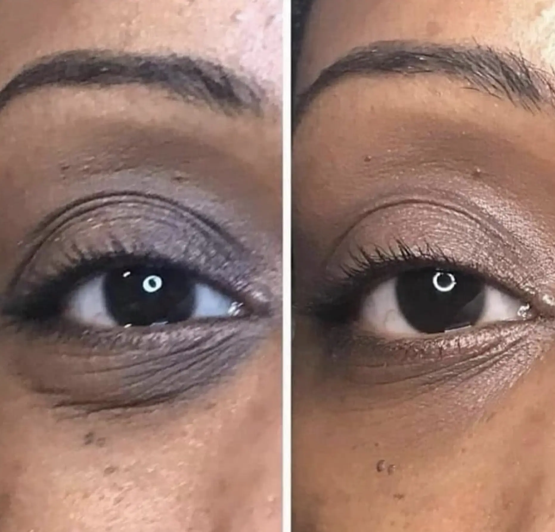 best dark circle eye treatment