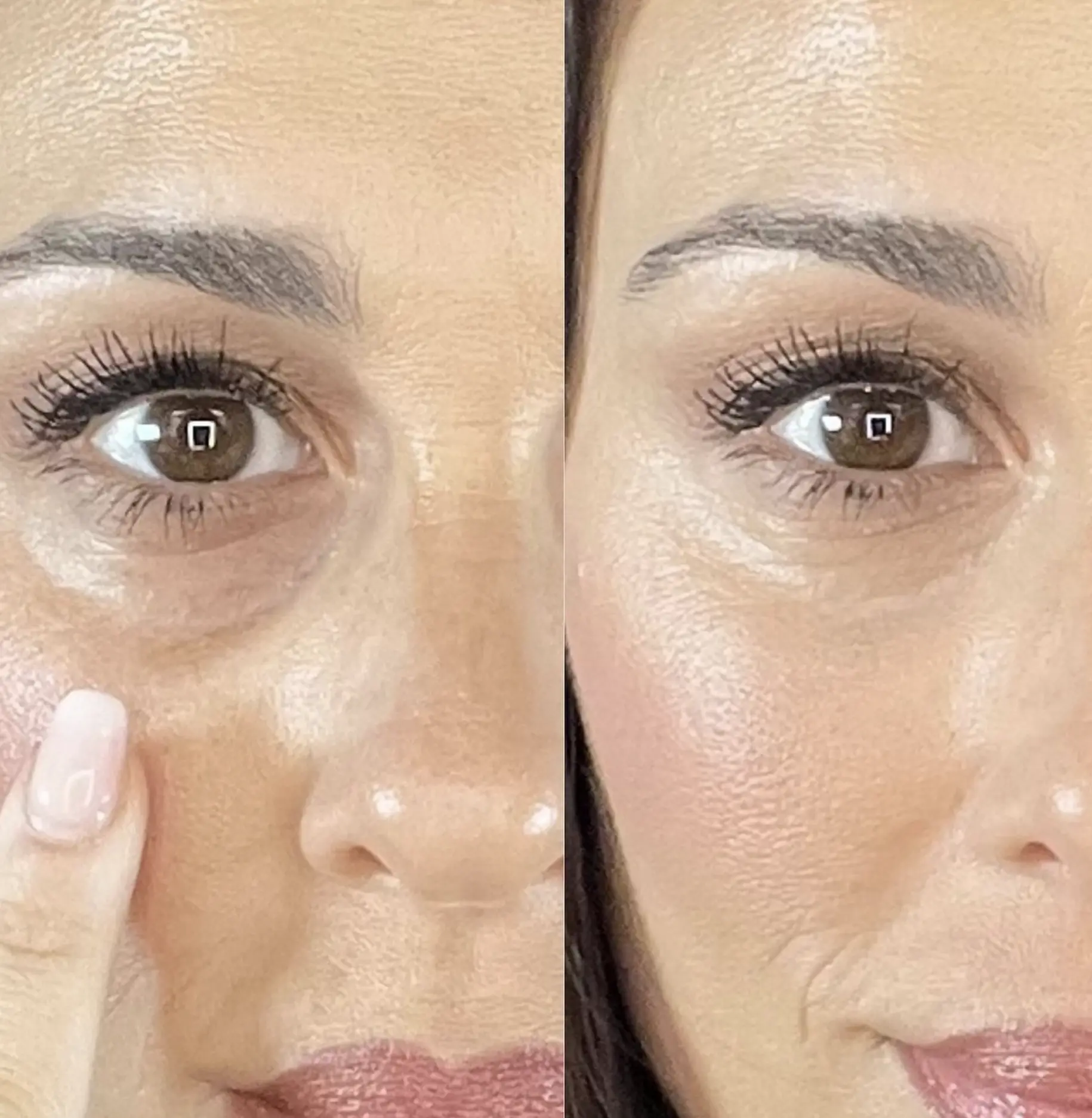 dark circle treatments
