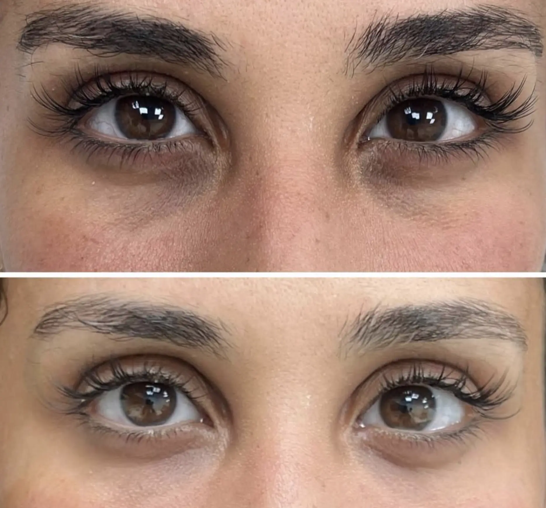 how to get rid of dark circles and eye bags