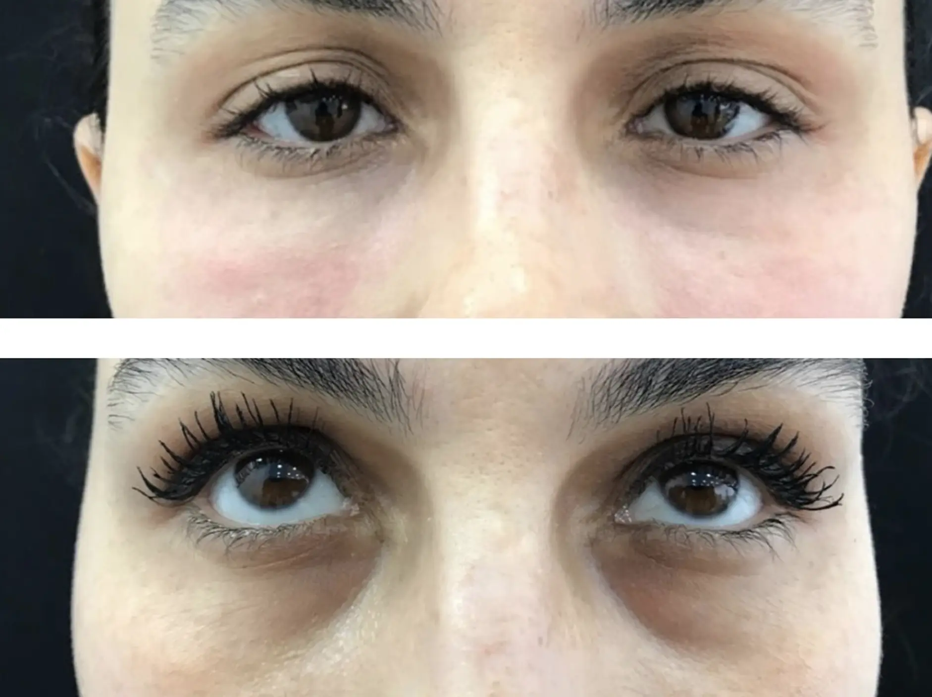 how to get rid of the dark circles under eyes