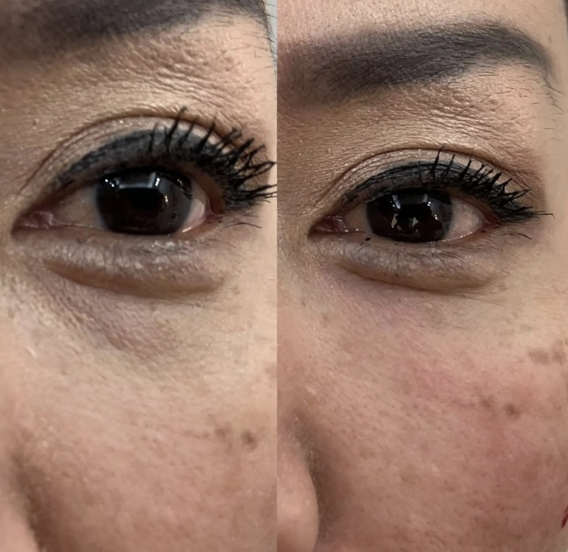 how to improve dark circles under eyes